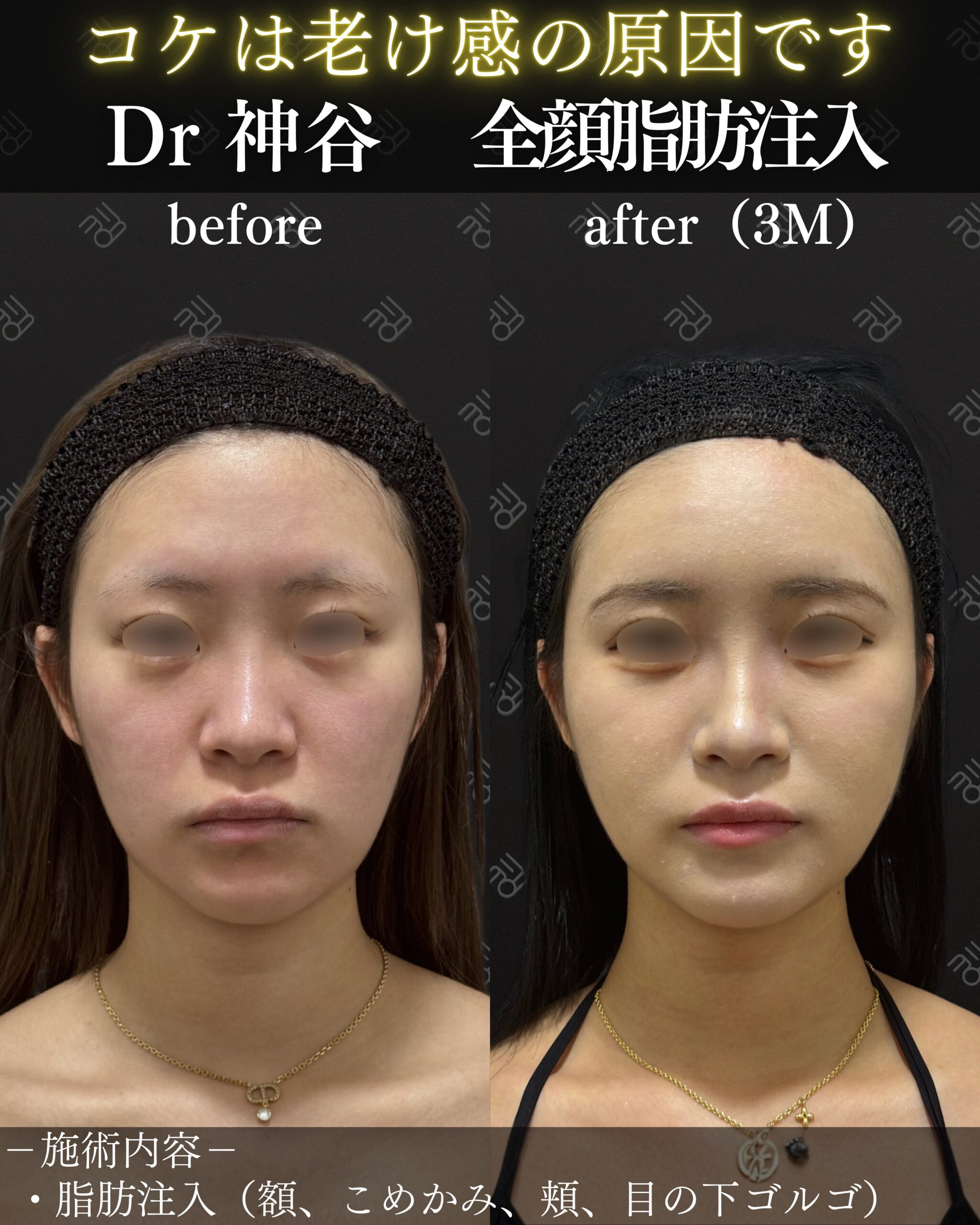 顔のコケ感や影を改善し、ふっくらと若々しい印象への写真(福井県敦賀市)